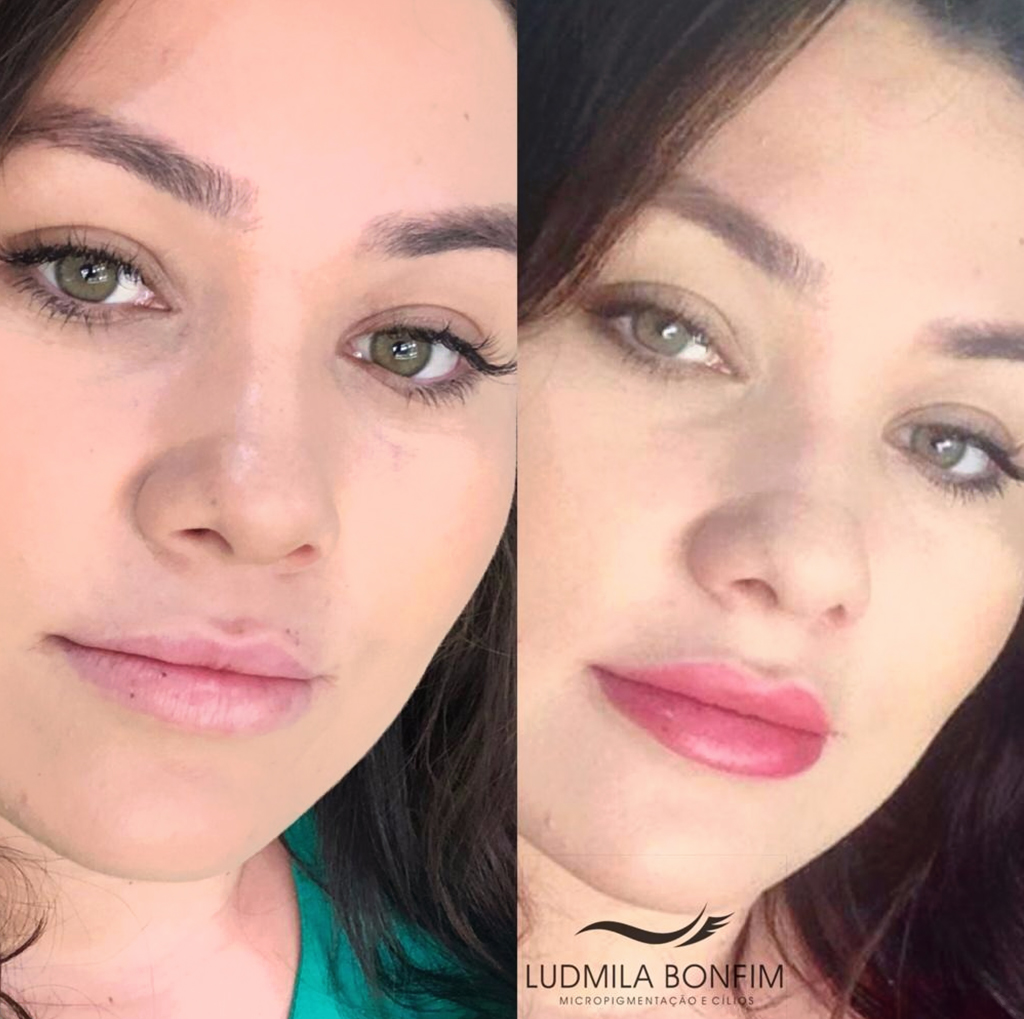 Revitalização Labial em Brasília no Espaço Ludmila Bonfim