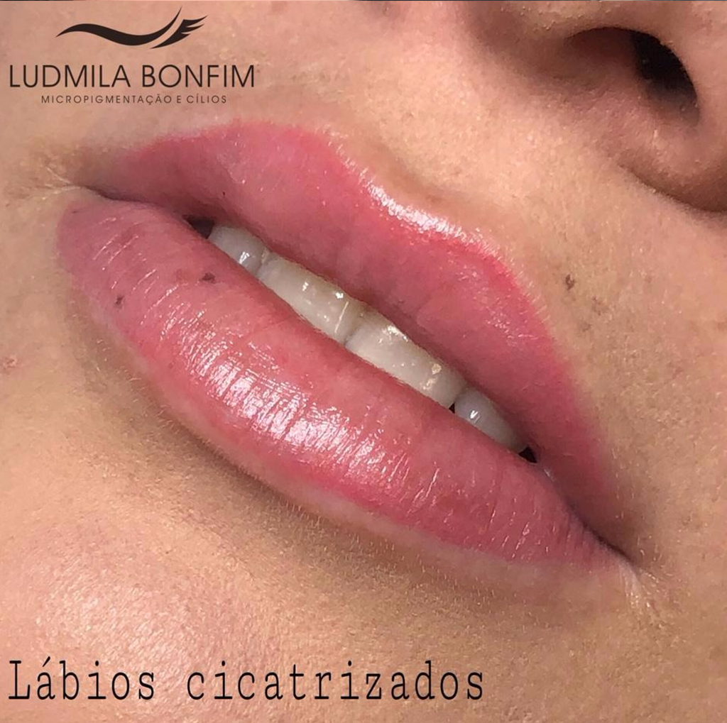 Revitalização Labial em Brasília no Espaço Ludmila Bonfim
